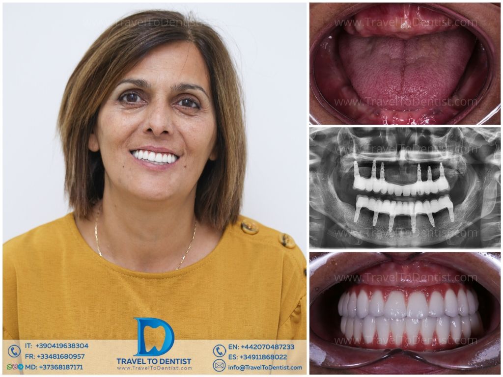 Caso clínico de transformación dental 5